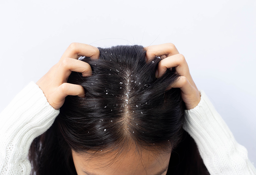 dry-hair-dandruff-recommendation